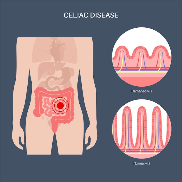 Celiac disease. Damaged and healthy Intestinal villi in surface area of intestinal walls.