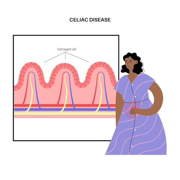 Вектор Воспаление при глютеновой болезни. поврежденные ворсинки кишечника в области поверхности стенок кишечника.