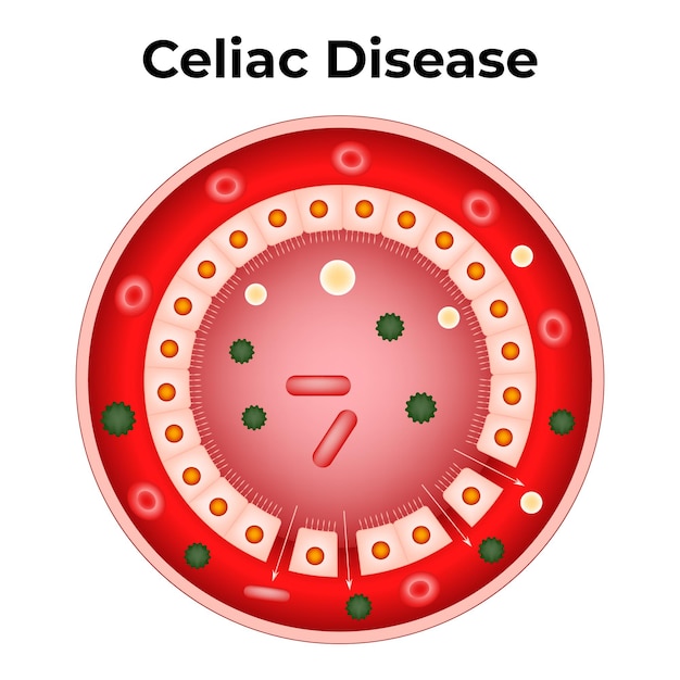 Vector celiac disease vector illustration