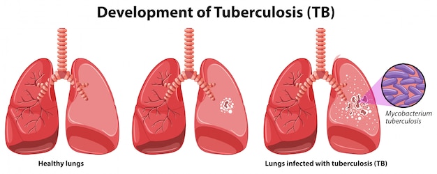 Vettore grafico che mostra lo sviluppo della tubercolosi