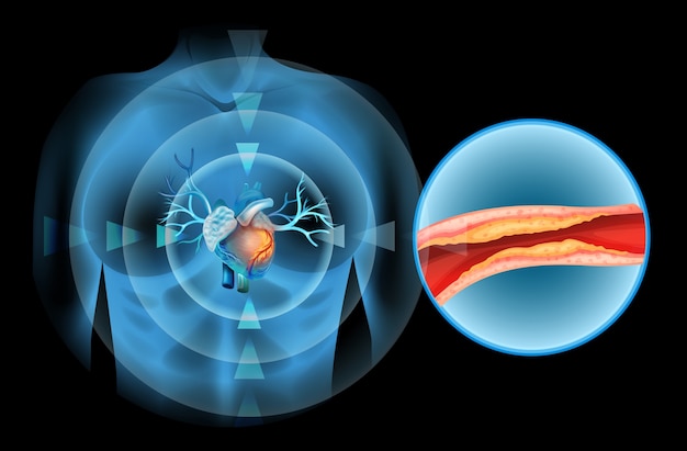 Cholesteral clocked in human heart