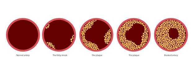 Cholesterol and atherosclerosis