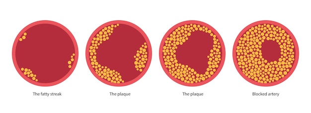 Vector cholesterol and atherosclerosis