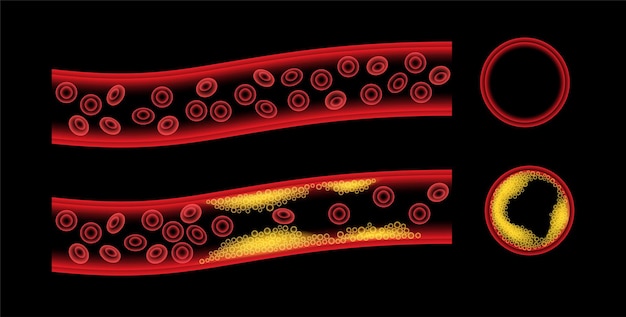 Vector cholesterol and atherosclerosis