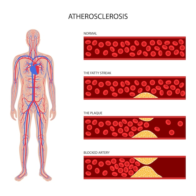 Vector cholesterol and atherosclerosis