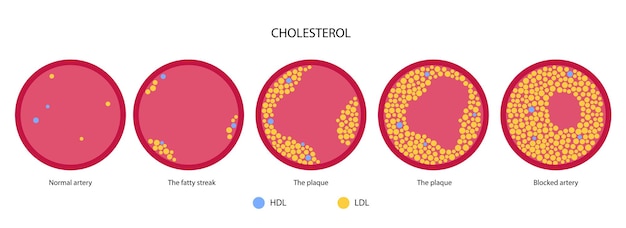 Vector cholesterol bloedslagader