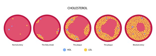 Холестерин крови артерии
