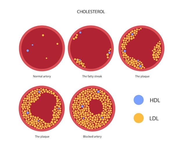 Vector cholesterol blood artery