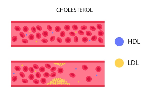 Vector cholesterol blood artery