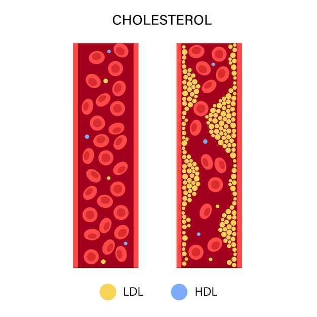 Vector cholesterol blood artery