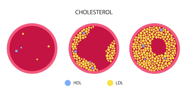 Vector cholesterol blood artery