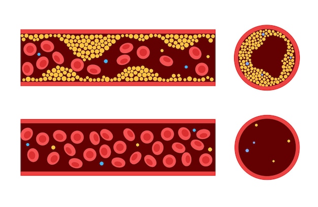 Vector cholesterol blood artery