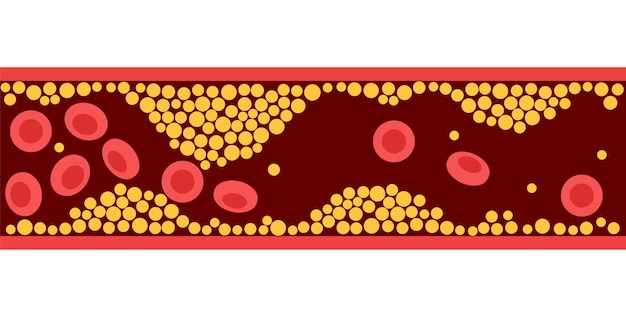 Cholesterol en atherosclerose