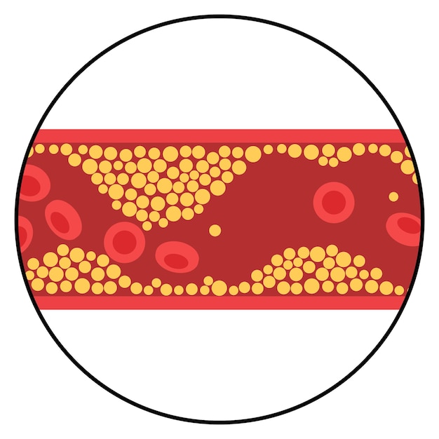 Vector cholesterol en atherosclerose