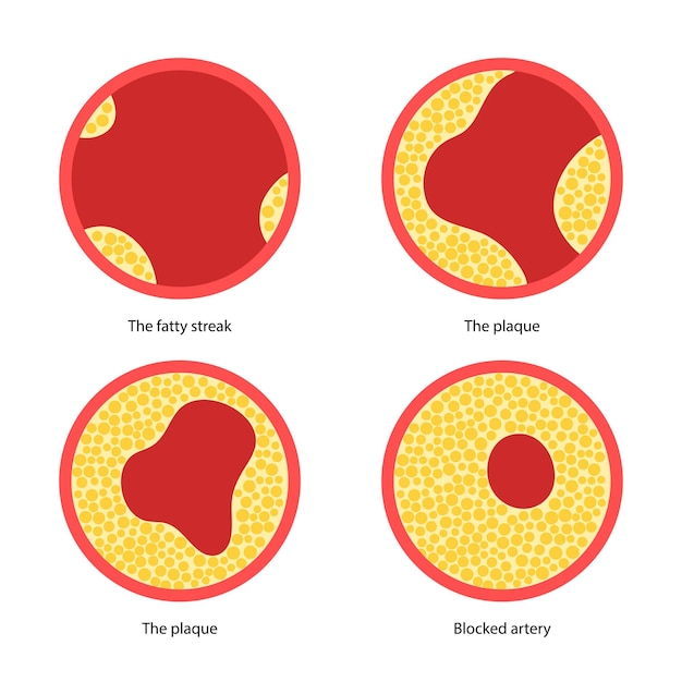 Cholesterol en atherosclerose