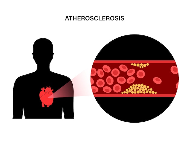 Cholesterol hartziekte