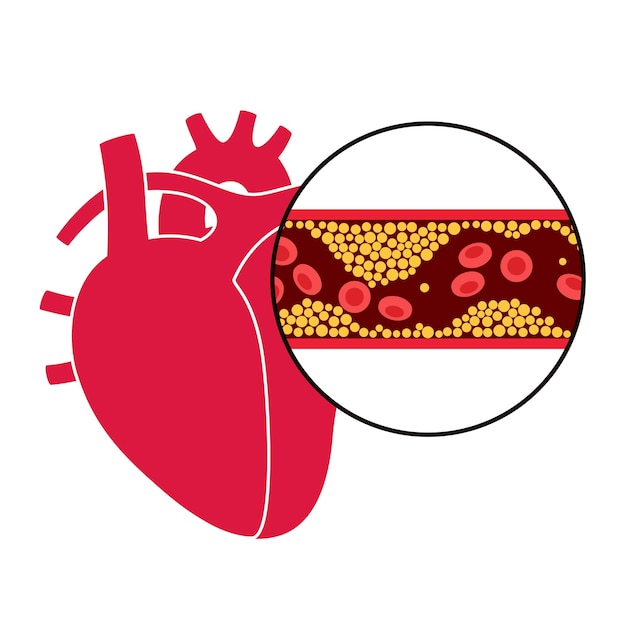 Cholesterol hartziekte