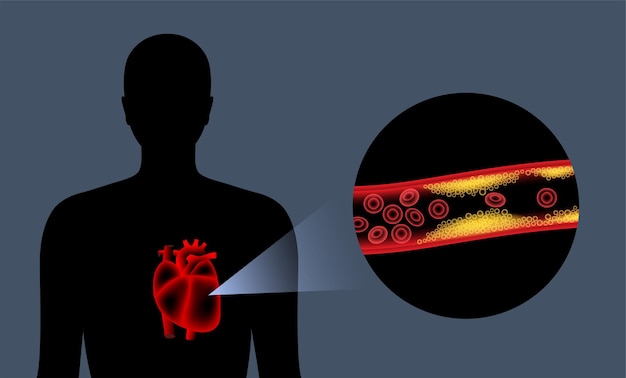 Malattie cardiache da colesterolo