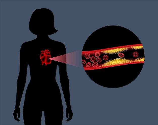 Vettore malattie cardiache da colesterolo