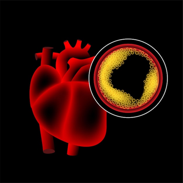 Malattie cardiache da colesterolo