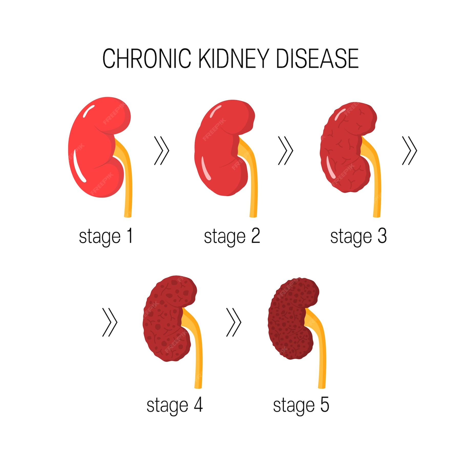 premium-vector-chronic-kidney-disease-concept