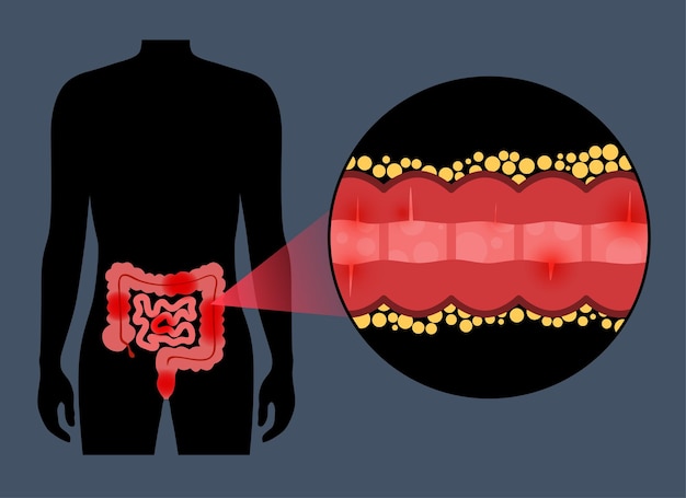 Chrons disease concept