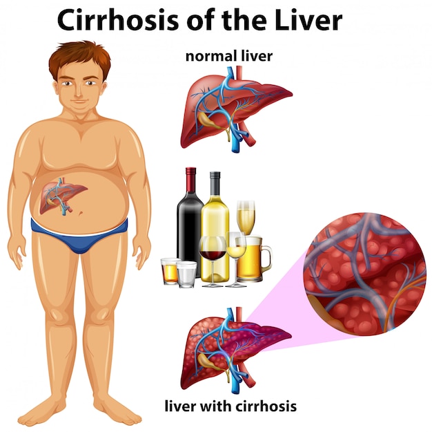 Cirrhosis of the Liver