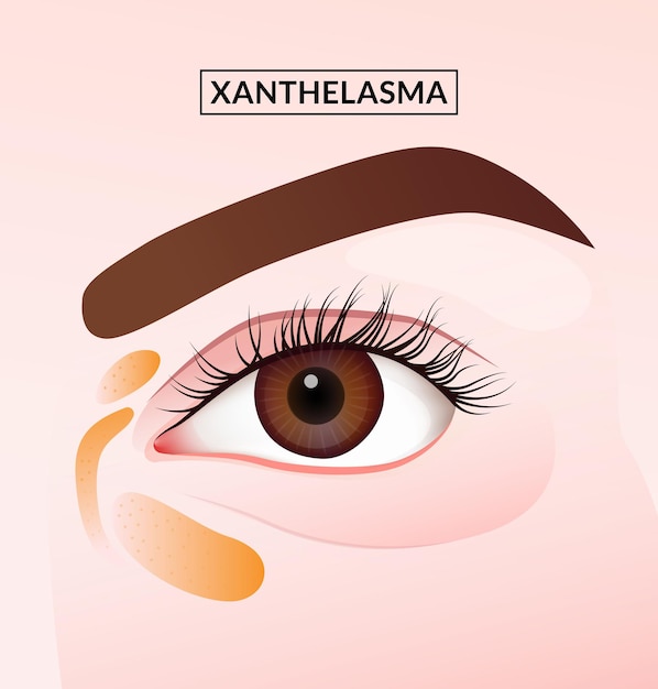 Vector closeup of woman close up of eyelid with xanthelasma