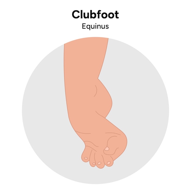 Vector clubfoot equinus