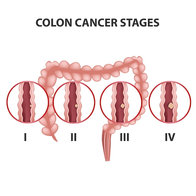 Colon cancer stage medical vector illustration