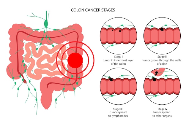 Colon cancer stage