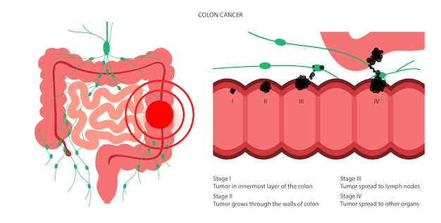 Colon cancer stage