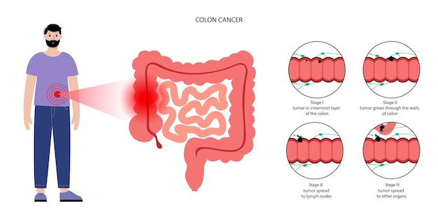 Colon cancer stage