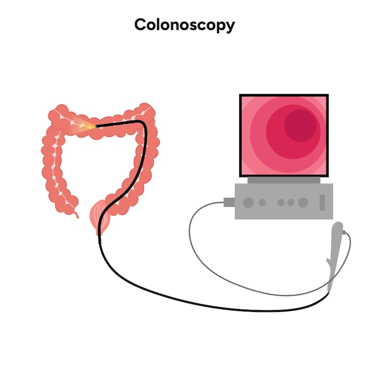 Vector colonoscopy and colonoscope