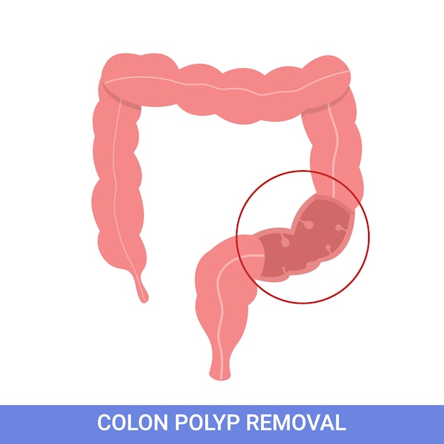 Colonoscopy intestine polypectomy procedure removal polyp in colon colon surgery