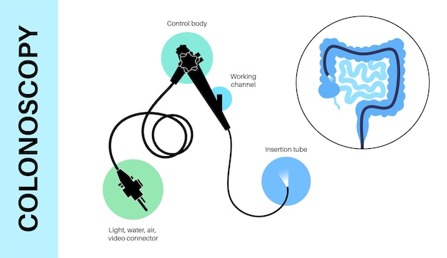 Vector colonoscopy is a minimally invasive procedure examination and treatment of the large intestine disorder of the colon polyps inflammation or swelling of bowel gastrointestinal disorder flat vector