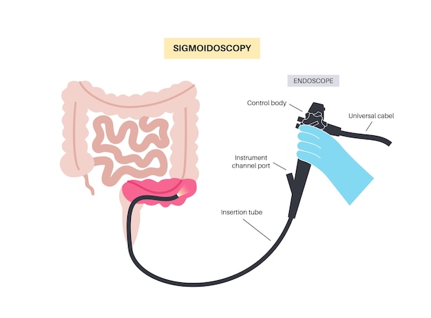 Colonoscopy and sigmoidoscopy test Examination and treatment of the large intestine Disorder of the colon inflammatory bowel disease constipation or incontinence Gastrointestinal medical vector