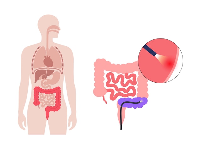 Vector colonoscopy treatment familial adenomatous polyposis examination and diagnosis of the large intestine fap medical examination bowel disease symptoms gastrointestinal disorder anatomical vector