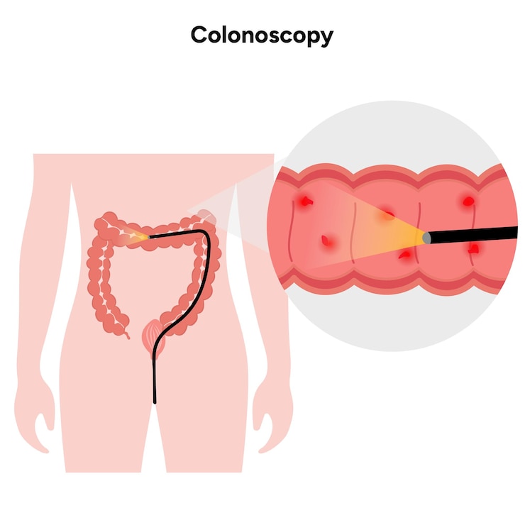 Vector colonoscopy zoom