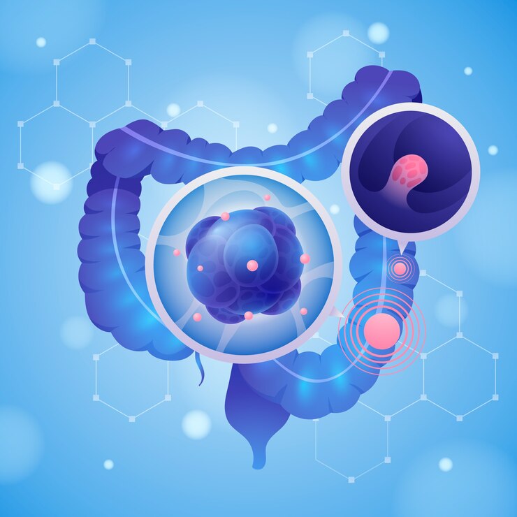 Vector colorectal cancer anatomy