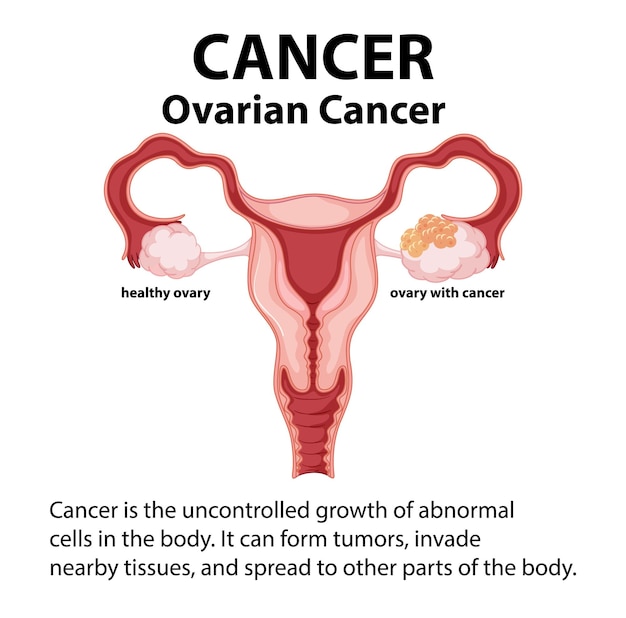 医学解剖学における正常卵巣と癌卵巣の比較 インフォグラフィック