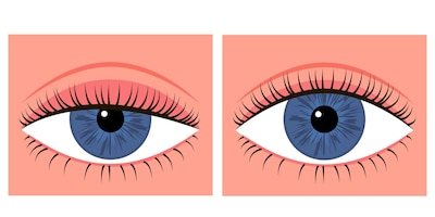 Comparison eye with down lid ptosis and healthy eye. blepharoplasty eyelid surgery, correction