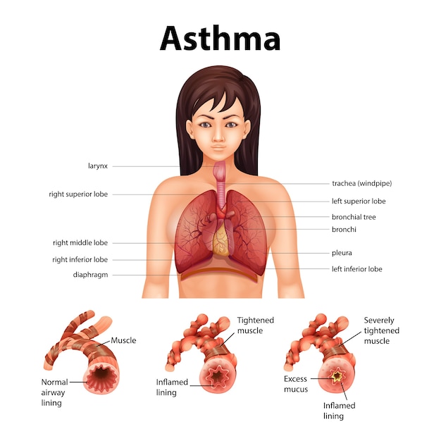 Comparison of healthy lung and Asthmatic lung