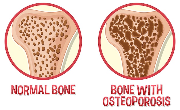 Vettore confronto tra osso normale e osso con osteoporosi