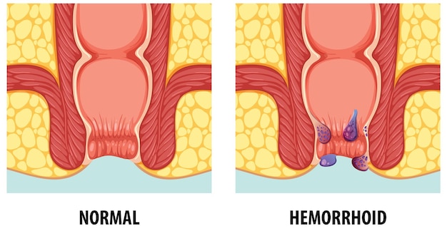 Vector comparison of normal and hemorrhoids in human anatomy