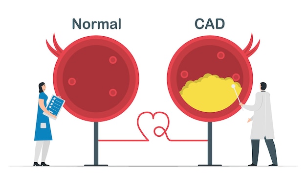 정상 심장과 관상 동맥 질환의 비교입니다. 흰색 배경에 고립 된 심장 벡터 일러스트 레이 션.