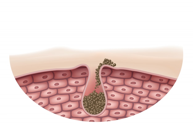 Il concetto di pelle che è l'acne