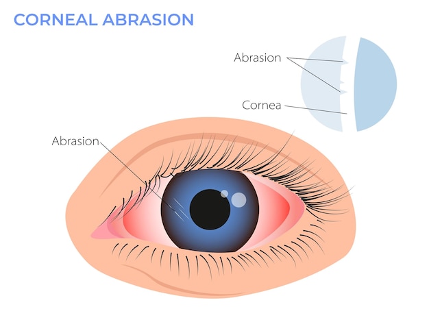 Vettore illustrazione dell'abrasione corneale sintomo di arrossamento degli occhi occhio del surfista rosso rosa