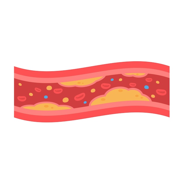 Coronary arteries with accumulated fat in the body