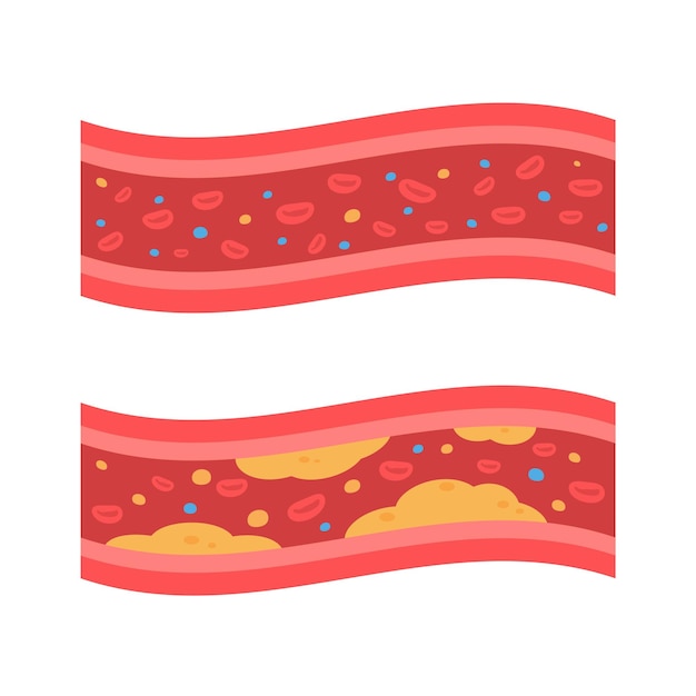 Arterie coronarie con grasso accumulato nel corpo